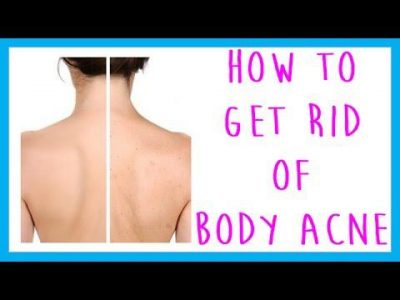 how to get rid of body acne