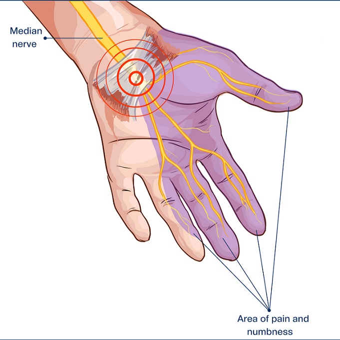 Symptoms of Carpal Tunnel Syndrome