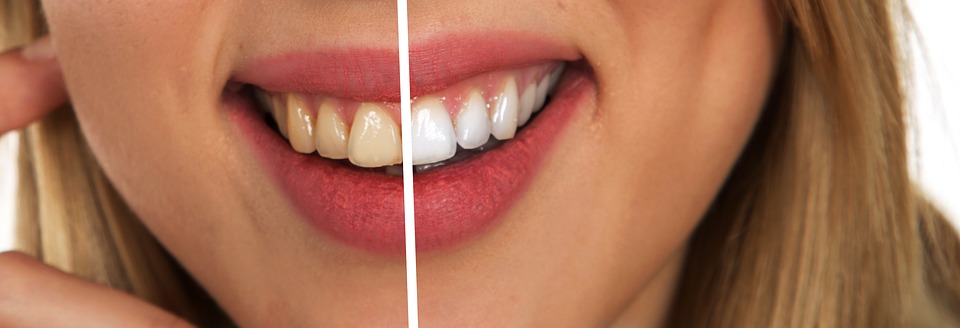 Tips for natural teeth whitening